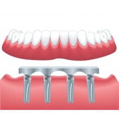 las vegas all on 4 dental implants