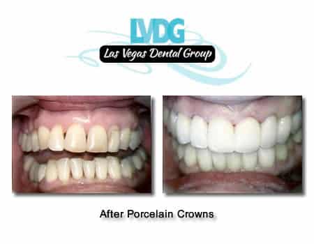 porcelain crowns